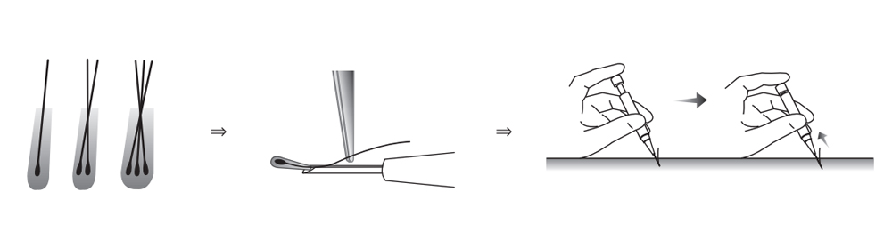 Hair Implanter how to use